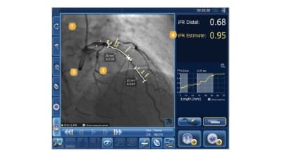 DEFINE PCI Unseen focal lesions cause residual ischemia