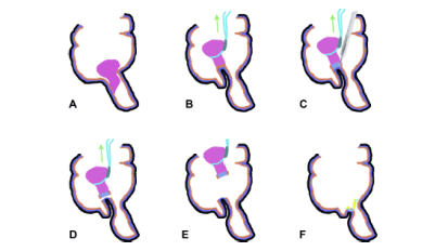 Endoscopic En Bloc Removal of Appendiceal Polyp Facilitated by Traction