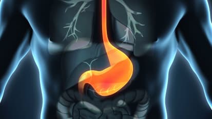 Fundoplication or Myotomy Patient CareMap