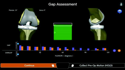 Smith+Nephew CORI&trade; Digital Tensioner for Total Knee Arthroplasty (TKA): Ligament Tensioning and Assessment Prior to Bone Resections