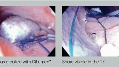 DiLumen™ - Assisted Colonic Underwater Endoscopic Mucosal Resection: Clinical Case Report