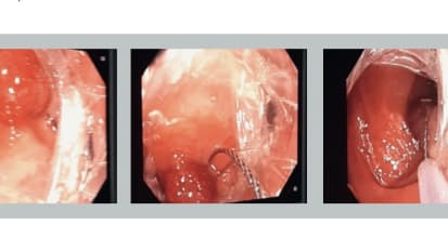 DiLumen™ - Assisted Complex Sigmoid Polyp Resection: A Case Report