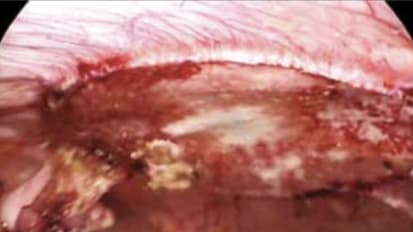 Mesh Selection for Hernia Repair: Expert Review of Biologic, Synthetic and Bioabsorbable Types