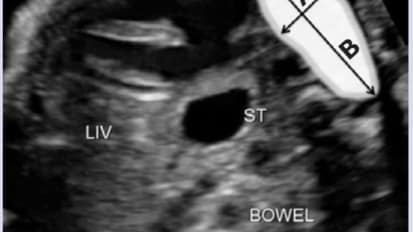 Assessing the Effectiveness of FETO, a New Experimental Therapy for Congenital Diaphragmatic Hernia