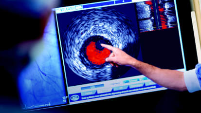 Volcano ChromaFlo Imaging: Enhanced clarity. Simple.