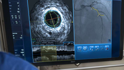 IVUS Imaging: No more stent regret