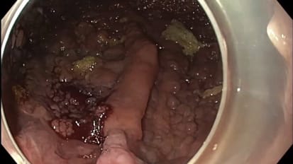 Rectal Reconstruction After Endoscopic Submucosal Dissection for Removal of a Giant Rectal Lesion