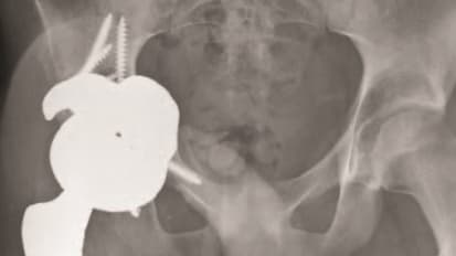 Surgical and Medical Management of Osteosarcoma Clinical Briefing