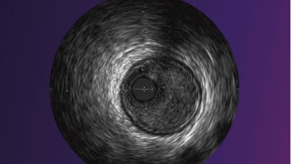 Rotational IVUS image interpretation Pocket guide