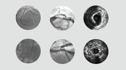 Six scenarios in which to consider IVUS for coronary artery disease