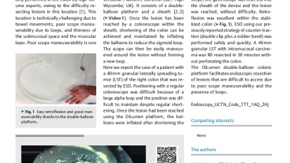 Endoscopic Submucosal Dissection of a Laterally Spreading Tumor in the Right Colon With a Gastroscope After Shortening the Colon Using a New Double-Balloon Platform