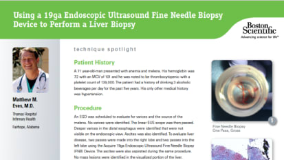 Using a 19ga Endoscopic Ultrasound Fine Needle Biopsy Device to Perform a Liver Biopsy Presented by Matthew M. Eves, M.D. Thomas Hospital Infirmary Health, Fairhope, Alabama, U.S.A.