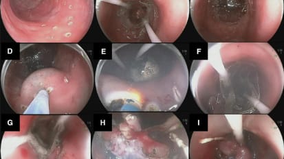 Facilitating Endoscopic Submucosal Dissection: Double Balloon Endolumenal Platform Significantly Improves Dissection Time Compared with Conventional Technique