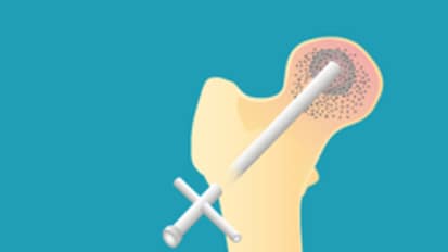 Core Decompression Treats Early-Stage Osteonecrosis of the Hip