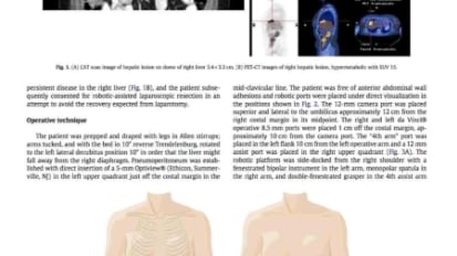 Robotic-assisted resection of liver and diaphragm recurrent ovarian carcinoma: Description of technique