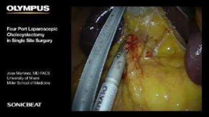 LESS Cholecystectomy