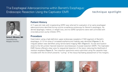 T1a Esophageal Adenocarcinoma within Barrett’s Esophagus: EMR, Carlos Micames, MD