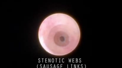 Use of a Basket to Stretch Stenotic Webs