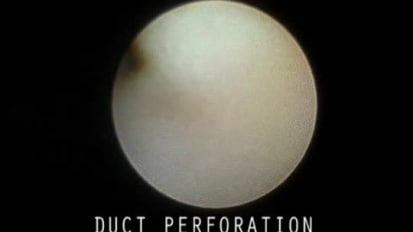 Perforation of the Duct Wall by an Endoscope