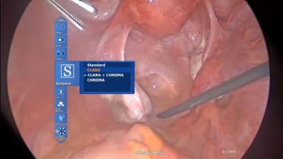 Use IMAGE1 S for Ovarian Cystectomy