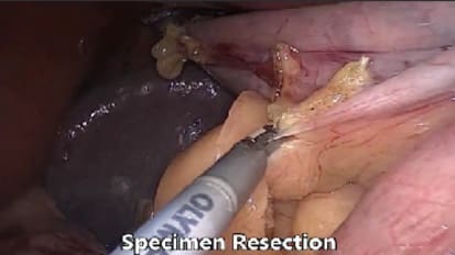 Laparoscopic Sleeve Gastrectomy