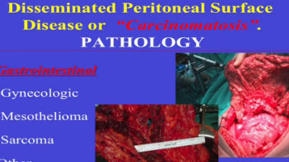 Defining a Peritoneal Surface Malignancy Center of Excellence Edward Levine, MD 