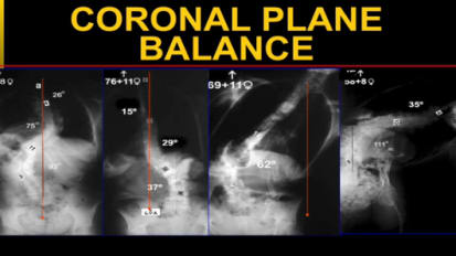 Adult Scoliosis: What You Need to Know About the Crooked Spine: Alexander K. Powers, M.D.