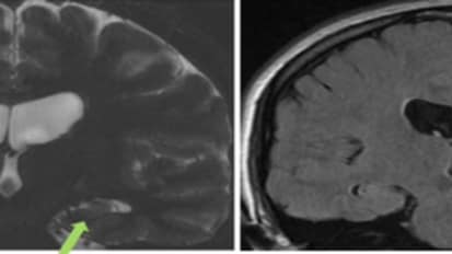 Current Surgical Management of the Epilepsy Patient: Heidi Marie Munger Clary, M.D., M.P.H.