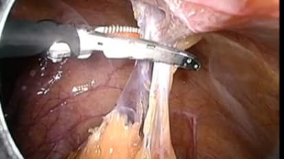 Total Laparoscopic Hysterectomy with PKS Omni