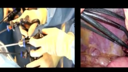 LESS Cholecystectomy Suggestions & Tips: Step 5 - Controlling the Flexible Tip Scope