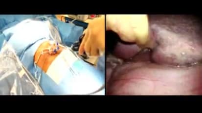 LESS Cholecystectomy Suggestions & Tips: Step 4 - Inserting the ENDOEYE FLEX 5