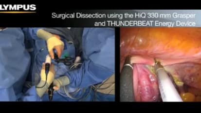 LESS Hysterectomy - A Recommended Standardized Approach 
