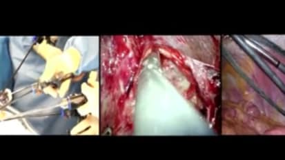 LESS Cholecystectomy Suggestions & Tips: Step 10 - Dissecting Calot's Triangle