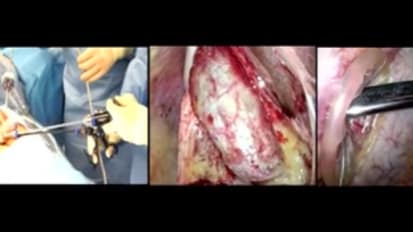 LESS Cholecystectomy Suggestions & Tips: Step 9 - Inserting the Infundibular Grasper and the Maryland Dissector