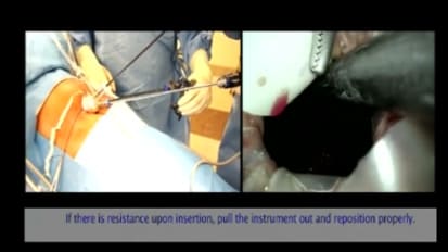 LESS Cholecystectomy Suggestions & Tips: Step 8 - Two Instrument Dissection for Initial Exposure