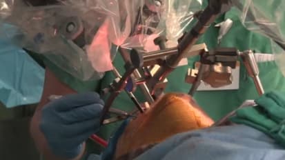 Transoral Robotic Surgery (TORS) for Excision of Right Tongue Base Cancer