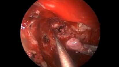 Endoscopic Surgery for Residual Pituitary Microadenoma