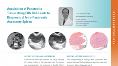 Acquisition of Pancreatic Tissue Using EUS FNA Leads to Diagnosis of Intra-Pancreatic Accessory Spleen