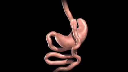 Roux-en-Y Gastric Bypass