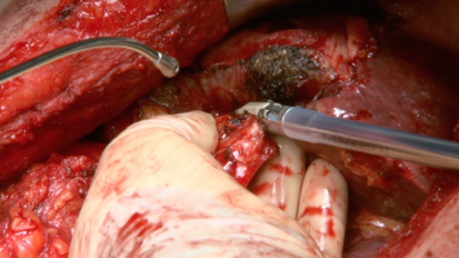 Right Hepatectomy