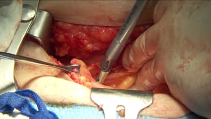 Total Abdominal Hysterectomy with THUNDERBEAT Open Extended Jaw