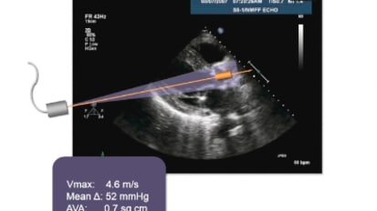 Progress in Aortic Stenosis: New Insights, New Options, New Challenges – Cardiology Grand Rounds