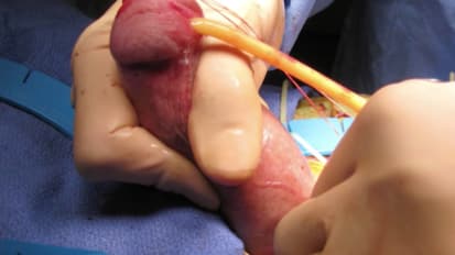 Penile Prosthesis Placement with Incision and Tutoplast Grafting - Laurence Levine, MD