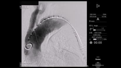 Novel procedure: Transcaval approach to TEVAR