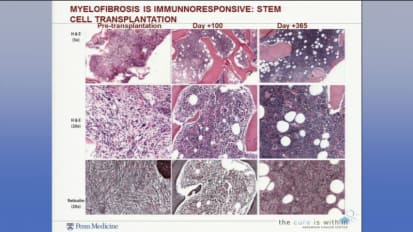 Case Studies in the Myeloproliferative Neoplasms