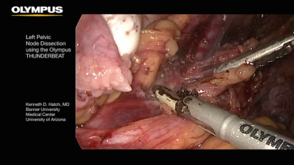 Left Pelvic Node Dissection with THUNDERBEAT