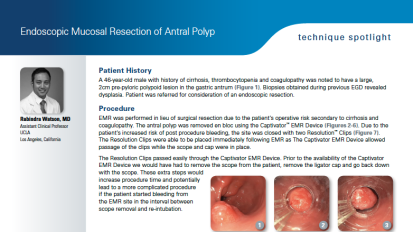 Endoscopic Mucosal Resection of Antral Polyp, Rabindra Watson, MD