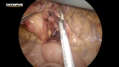 Ileocolectomy