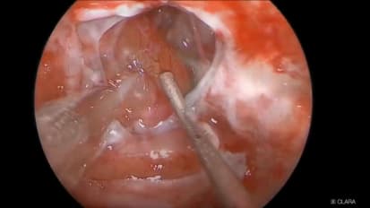 Use of CLARA in Treating a Suprasellar Craniopharyngioma Resection