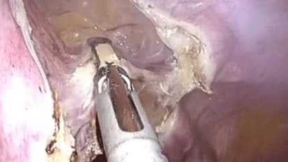 Single-Site Laparoscopic Supracervical Hysterectomy (LSH)